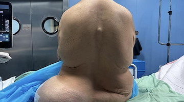 Napoli, 47enne conviveva con l’intestino nel gluteo e nella gamba: operato con successo al Monaldi